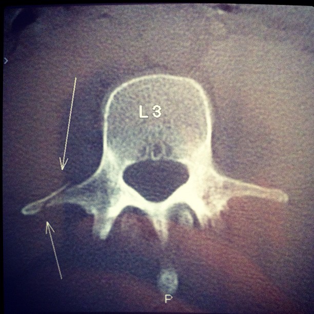 fracture-vertebre-lombaire.jpg