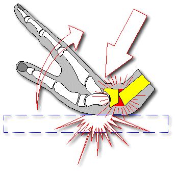 Mécanisme des fractures du poignet en snowboard. Copyright Skimeter.