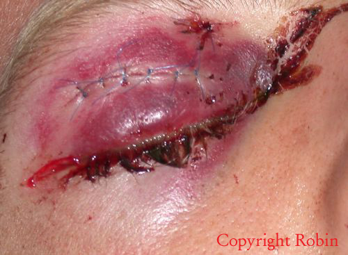 This young surfer took the nose of another surfer’s board in his right eye : it required 9 stitches and fortunately he didn’t lose the vision. Copyright Robin / www.surf-prevention.com