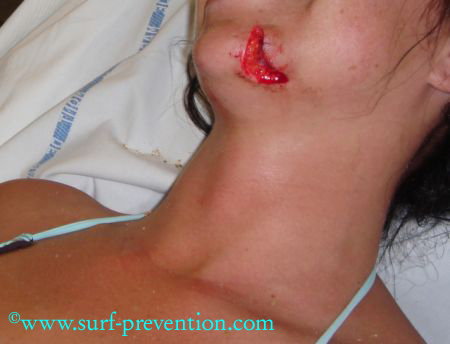 Young surfer girl who suffered a chin gash caused by the fin of her longboard that required 7 stitches. Copyright www.surf-prevention.com