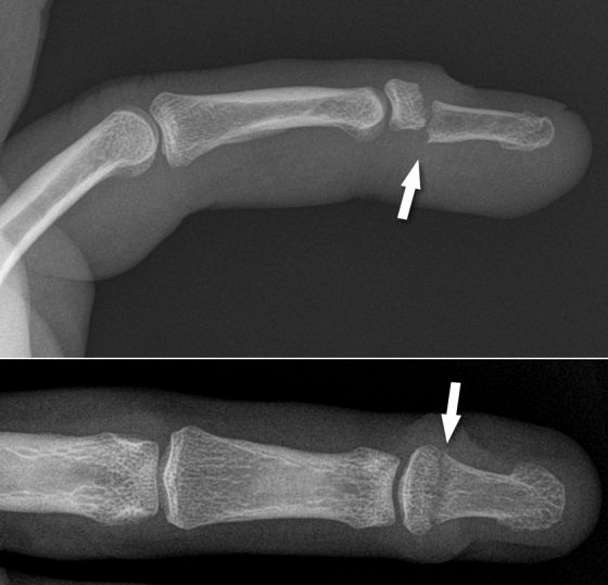 Fracture de la troisième phalange d’un doigt avec un leash chez un surfeur. Image Dr Paul Ardilouze