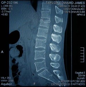 Fracture de L1 par accident de surf - blessure en surf - traumatisme lombaire - image scanner - tassement vertebral