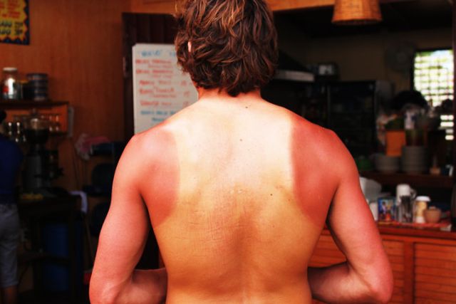 Greg Long surfeur victime d'un gros coup de soleil - brulure deuxieme degre soleil - bronzage insolite - bronzage agricole