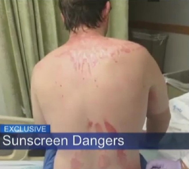 Accident domestique: il prend feu après avoir appliqué de la crème solaire en spray