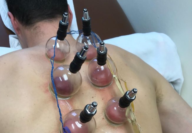 cupping